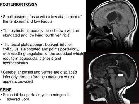 Anomalies of the posterior fossa .